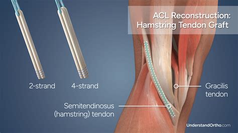 Procedure done for a hamstring graft